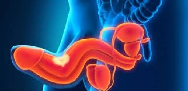 peyronie cuervature andropeyronie extender