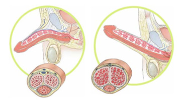 peyronie cuervature penis andropeyronie  PEYRONIE VERLÄNGERUNG Peniskrümmung  extender pene curcatura estensore extensor allungar verge allongement alargamiento 12.jpg
